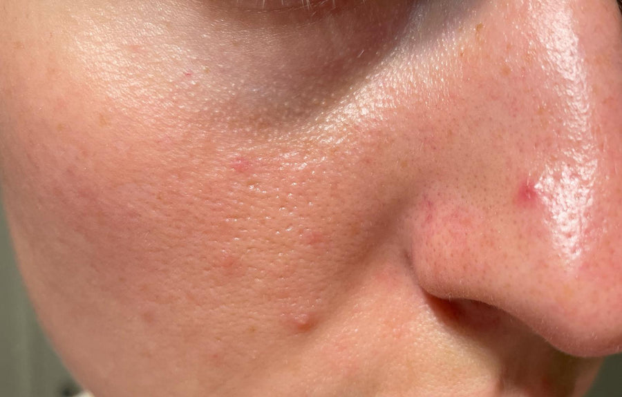 How to Get Rid of a Pimple Overnight