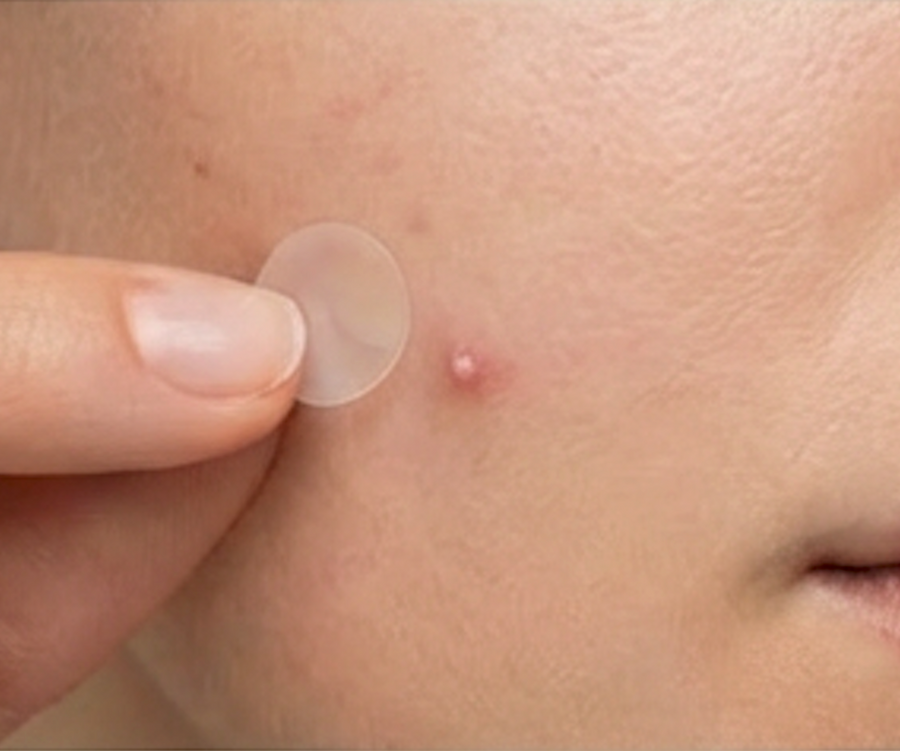 How to Heal a Popped Pimple