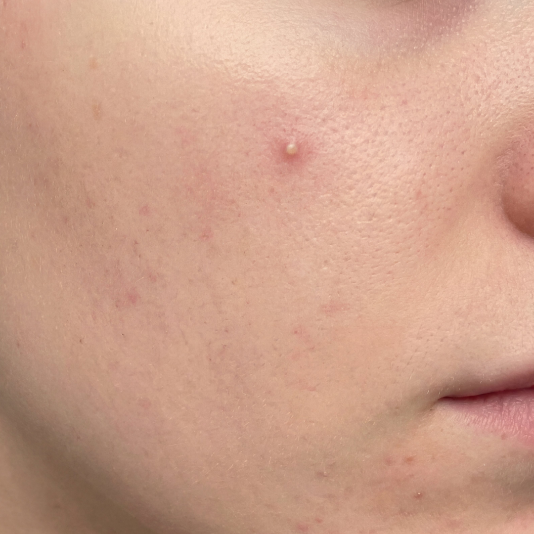 Funkar finnplåster egentligen — eller är det bara hype?